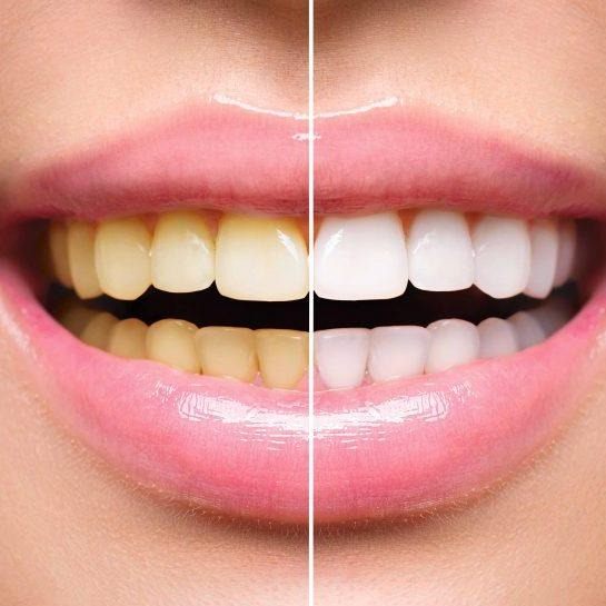 Teeth Whitening & Tooth Gem Combo Training